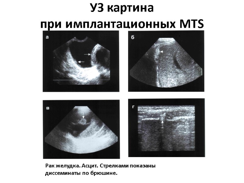 УЗ картина  при имплантационных MTS Рак желудка. Асцит. Стрелками показаны диссеминаты по брюшине.